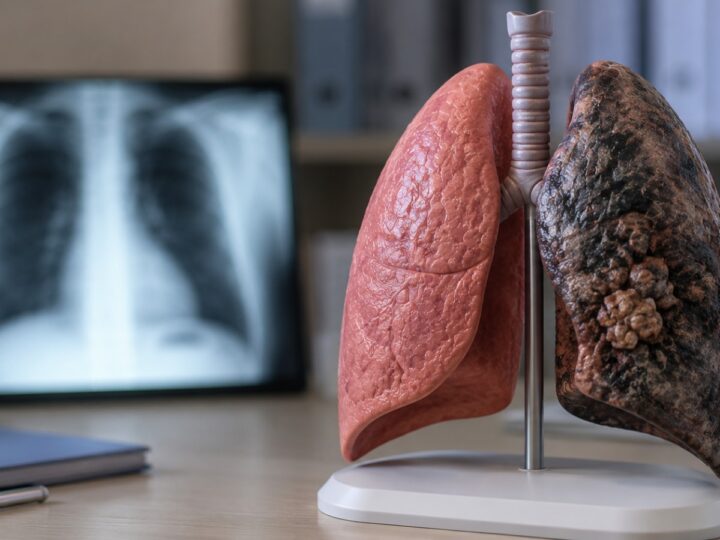 Diagnóstico tardio ainda é o principal obstáculo no combate ao câncer de pulmão, que faz milhares de vítimas no país